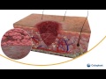 Wound Healing Processes and Phases