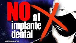 Muchos CAEN en el mismo ERROR por NO saber Esto al REEMPLAZAR DIENTES PERDIDOS con IMPLANTES