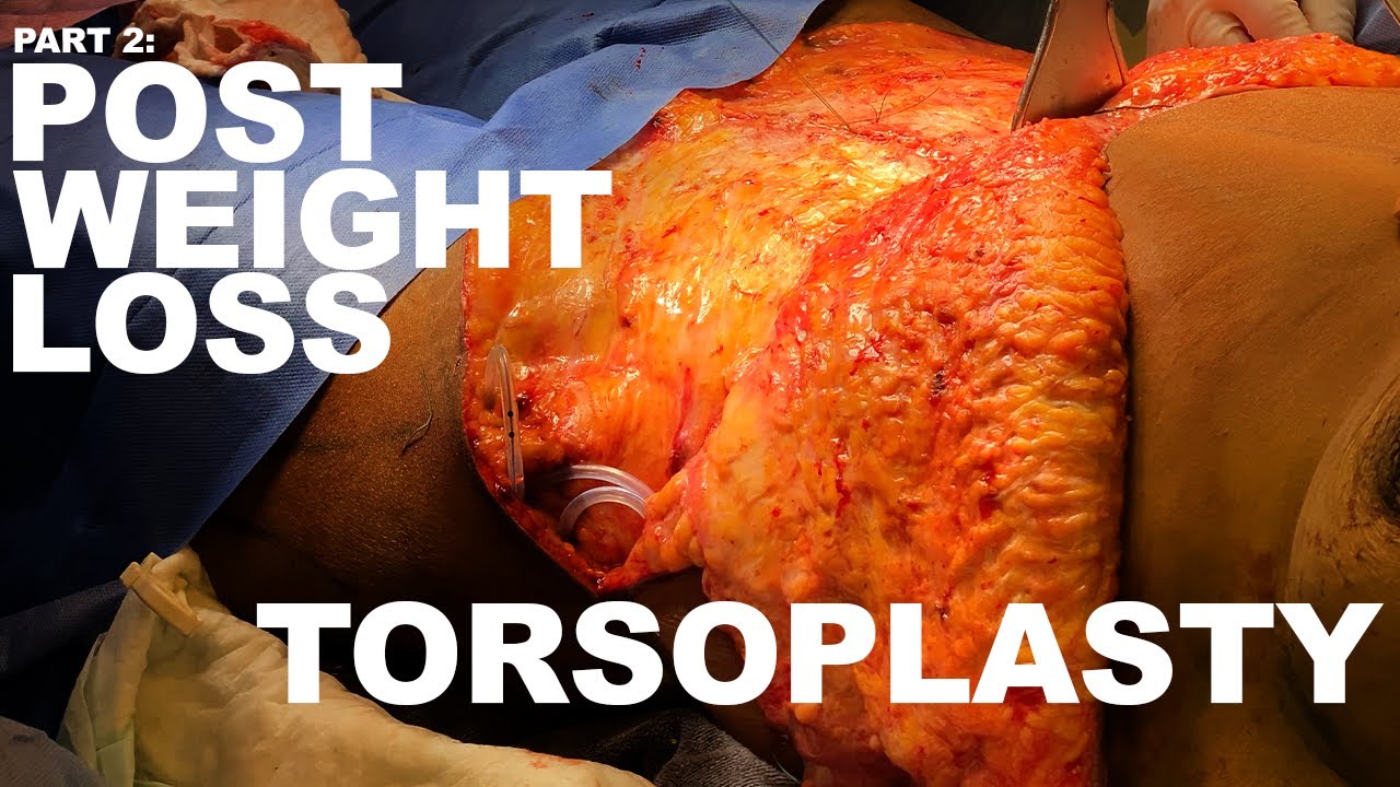 Surgical procedure for post-weight loss torso adjustment.