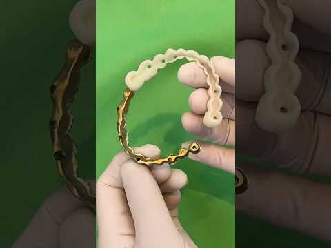 아이바 + <strong>pmma</strong> #dentist #dentalprosthesis #dental #dentalartistry
