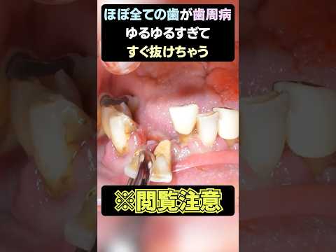 ※閲覧注意💦　ほぼすべての歯が歯周病でした...【後編】 #歯医者  #dentist #抜歯 #歯石除去 #歯石 #tartar #ショート #shorts