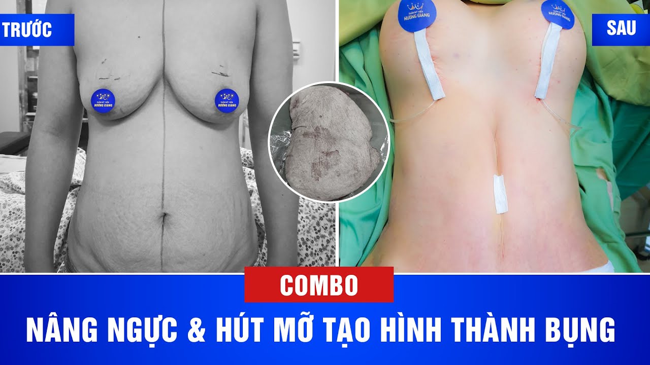 Nâng ngực và hút mỡ tạo hình thành bụng: Đẹp mãn nhãn