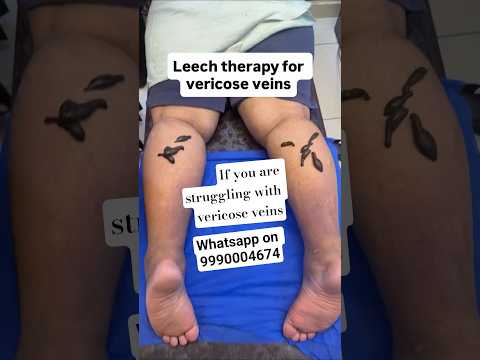 Leech Therapy in Ayurveda|Natural Blood Purification & Healing Therapy #ayurveda #paramanandayurveda