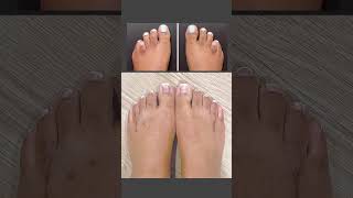 THE BRACHYBALANCING ™️ SURGERY FOR BRACHYMETATARSIA ❤️‍🔥 #brachymetatarsia #braquimetatarsia