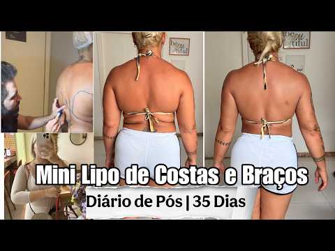 DIÁRIO DA MINI-LIPO NAS COSTAS E BRAÇOS | 35 DIAS