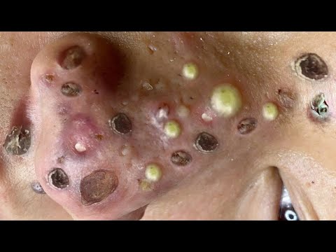 Blackhead Removal With Sac Dep Spa @100074548