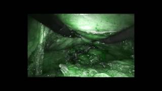 78. Robotic LAR with Xi system (firefly) -- by 郭立人醫師 (Li-Jen Kuo, MD)