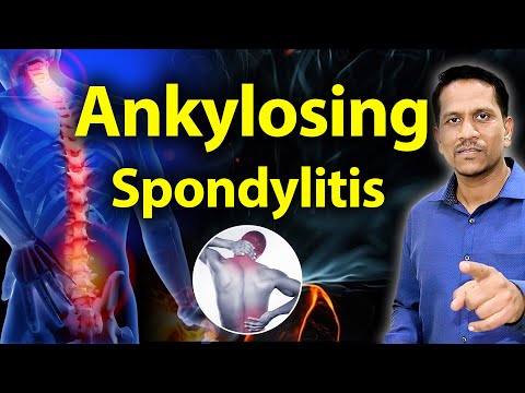 अँकिलोझिंग स्पॉन्डिलायटीस कारणे आणि उपचार | Ankylosing Spondylitis Symptoms | Dr Nagarekar ||