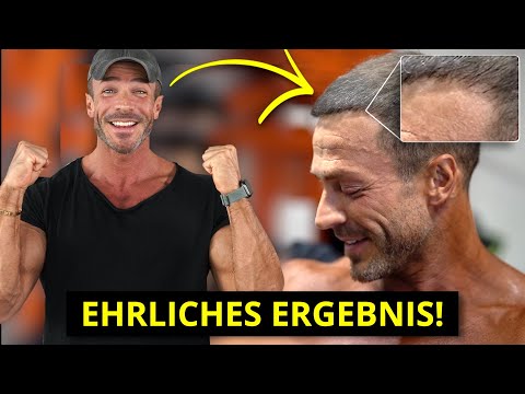Ergebnis meiner Haartransplantation nach 15 Monaten