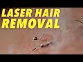 Understanding Laser Hair Removal