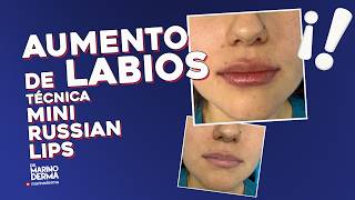 AUMENTO DE LABIOS CON LA TÉCNICA MINI RUSSIAN LIPS || Consejos de un dermatólogo