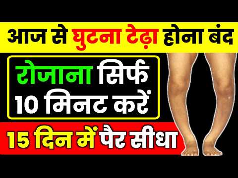 घुटने का गैप और टेढ़ापन का इलाज बिना सर्जरी|Knee Pain Exercises|Bow Leg Correction Exercises