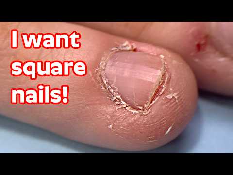 Extra DRY SKIN & bitten nails transformation with DUAL FORMS