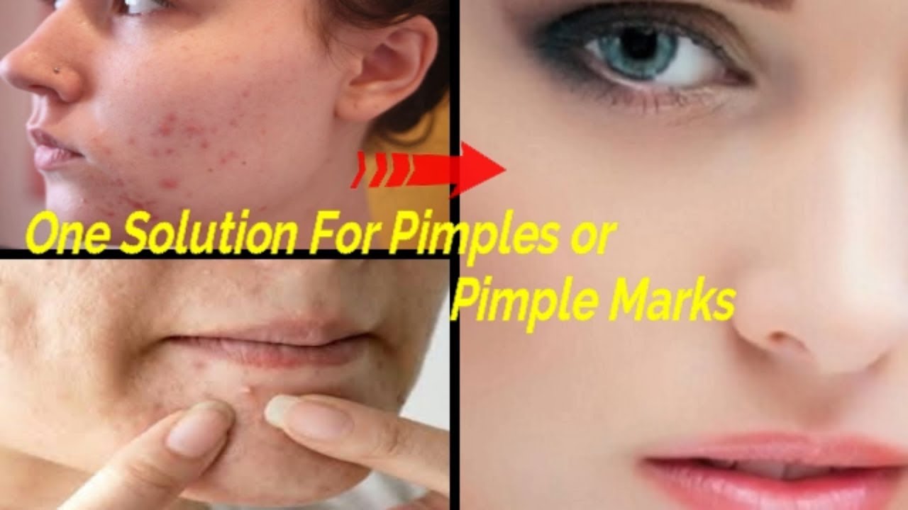 acne scars solution