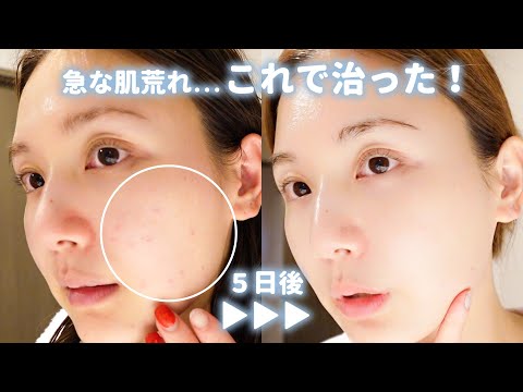 【肌荒れvlog】急なニキビ...？も5日間でここまで回復！美白も叶う私のレスキューアイテム紹介🧖‍♀️🌙【スキンケア】