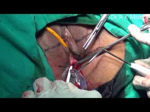 Tension free Vaginal Tape Obturator (TVTO)