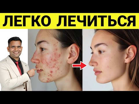 ИЗБАВЬТЕ СЕБЯ ОТ ПРЫЩЕЙ.