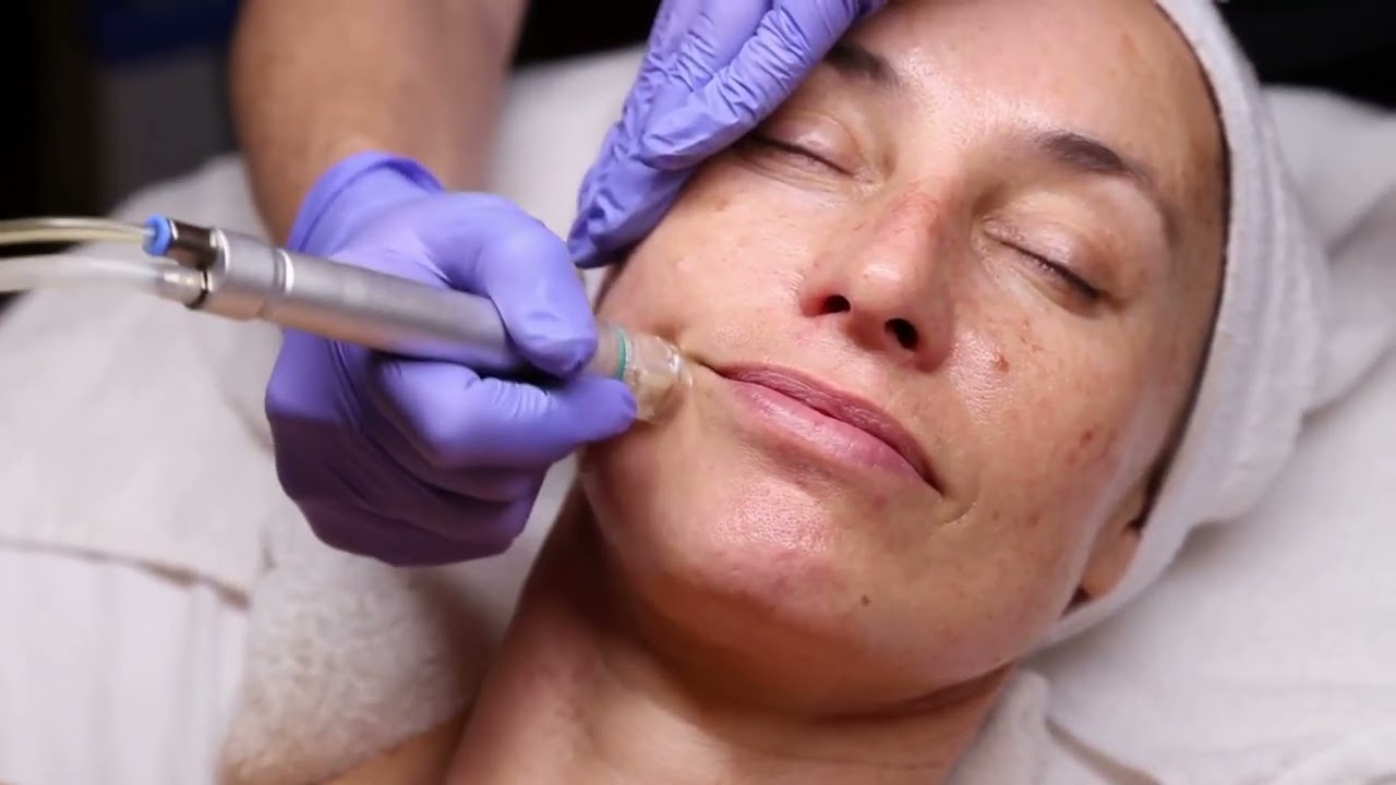Facial treatment procedure with a cosmetic device.