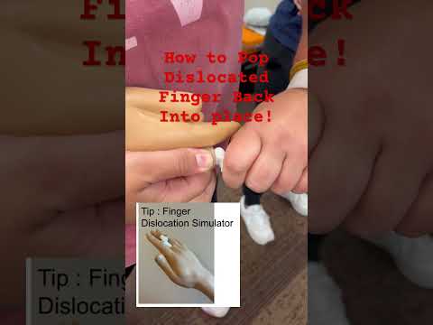 Finger Dislocation Reduction: Correct Technique to Avoid Damage (Tip Model Demo) #fingerdislocation