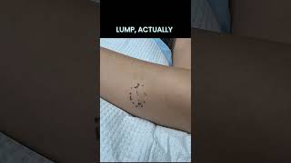 A forearm lipoma and a hidden blackhead behind the ear in the latest YouTube video! #drpimplepopper