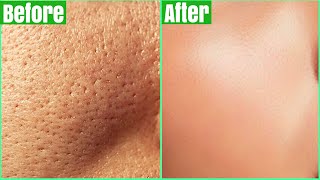 DIY MICRO-NEEDLING AT HOME FOR ACNE SCARS + PRODUCT FAVORITES FOR 2023