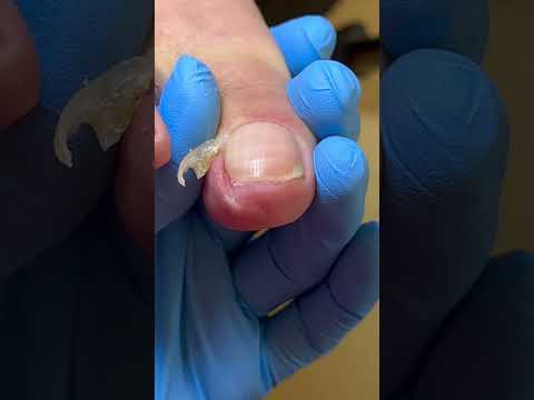 Silky Smooth Cut Away Ingrown Nails ~ Decompression #nails #satisfying