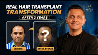 Real Hair Transplant Transformation After 3 Years