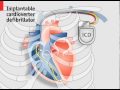 Cardiac Devices and Heart Function