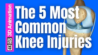 Top 5 Most Common Knee Injuries in Sports & How to Recover
