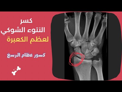 كسر النتوء الشوكي لعظم الكعبرة