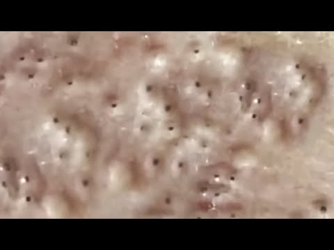 Blackheads & Whiteheads Satisfying Removal @0533