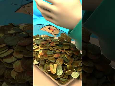 😳 লোকটা ১,৮৯৪টা কয়েন গিলে ফেলেছিল | He Swallowed 1,894 Coins