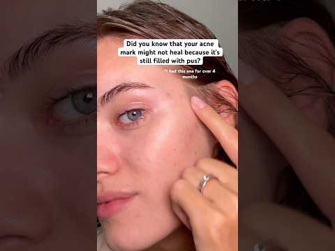 WHY post acne doesn’t heal?? #acneproneskin #acne #skincare #skincareforacne #acnetips #postacne