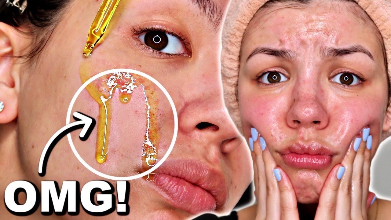 The oil cleansing method on oily skin - oil cleansing before and after - Audrey Victoria