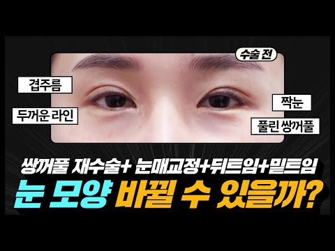 #풀린쌍꺼풀 #겹주름 고민🔥눈 모양 바뀔 수 있을까? (눈성형 당일편👀) #쌍꺼풀재수술 #눈매교정 #뒤밑트임