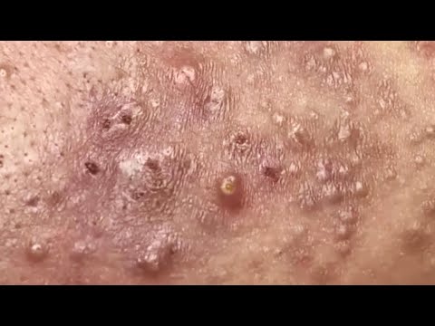 Blackheads & Whiteheads Satisfying Removal @0379