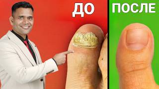 ДОМАШНЕЕ СРЕДСТВО ОТ ГРИБКА.