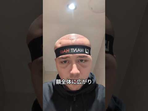 植毛手術でメガマインドになった!