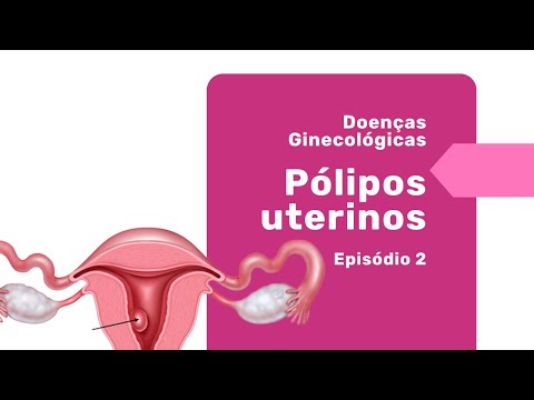 Pólipos uterinos: entenda o que são e suas consequências - Por Dr. Pedro Doria