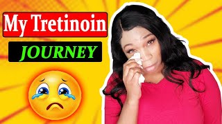 Tretinoin journey | how to clear acne in 30 days | Acne treatment | Pimple treatment | Acne removal