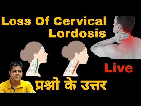 Loss of cervical lordosis. Cervical pain. #cervicalpain