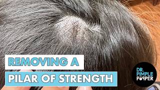 Removing a Pilar of Strength | Dr. Pimple Popper Removes a Pilar Cyst