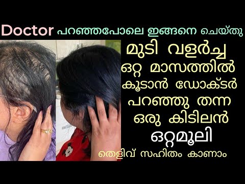 🔥Doctor പറഞ്ഞപോലെ ഇങ്ങനെ ചെയ്തു ഒരിക്കലും വളരില്ല എന്ന് വിചാരിച്ച😱 മുടി തഴച്ചു വളർന്നു🔥 Hair growth