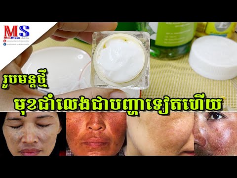 ជាំឈាម ជាំថ្ងៃ ជាំមានកូន ជាំដោយសារលាបម្សៅ អាចសាកល្បងជាមួយរូបមន្តថ្មីនេះបាន ប្រើបានគ្រប់ភេទ