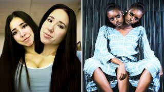 Descubra o mundo desconhecido dos gêmeos siameses: 15 casos extraordinários