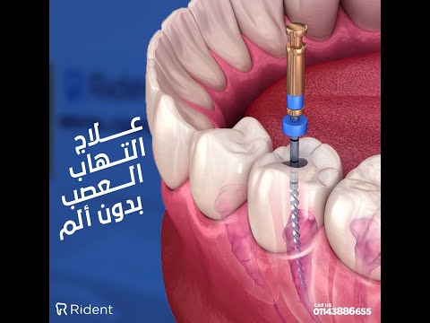 علاج عصب الاسنان لحياة بدون الم مع دكتور كريم اخصائى علاج جذور الاسنان