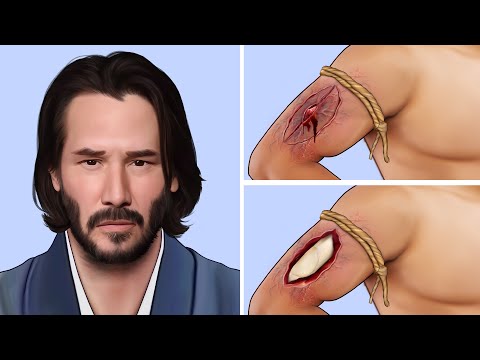 ASMR Remove Severely Injured Infected Arm - Deep Cleaning Animation