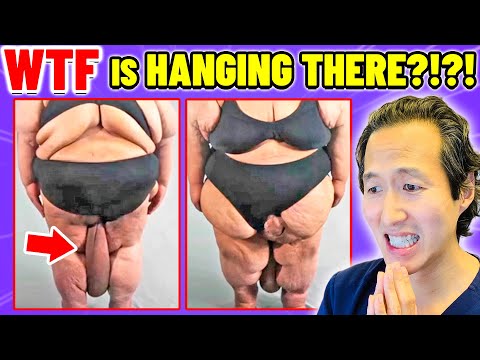 HUGE Mass! Plastic Surgeon Reacts to BOTCHED BARIATRICS!
