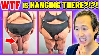 HUGE Mass! Plastic Surgeon Reacts to BOTCHED BARIATRICS!