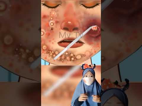 kumpulan Asmr infeksi 2 (luka pada kaki, tangan, muka dan kepala )|Mv #shorts